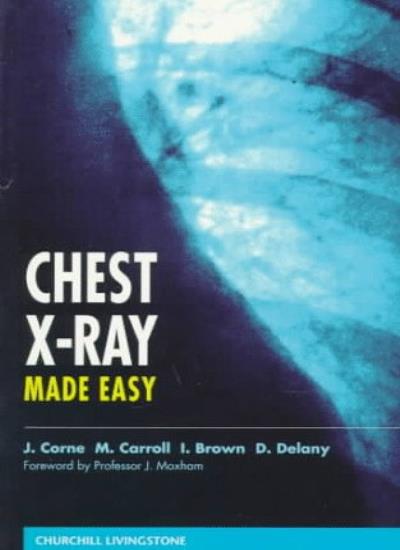 Chest X-ray Made Easy