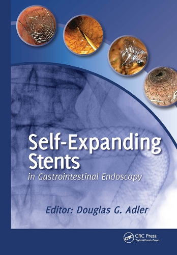 Self-Expanding Stents in Gastrointestinal Endoscopy