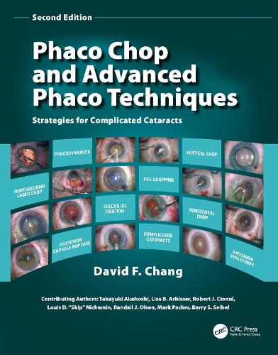 Phaco Chop and Advanced Phaco Techniques