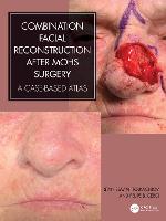 Combination Facial Reconstruction after Mohs Surgery